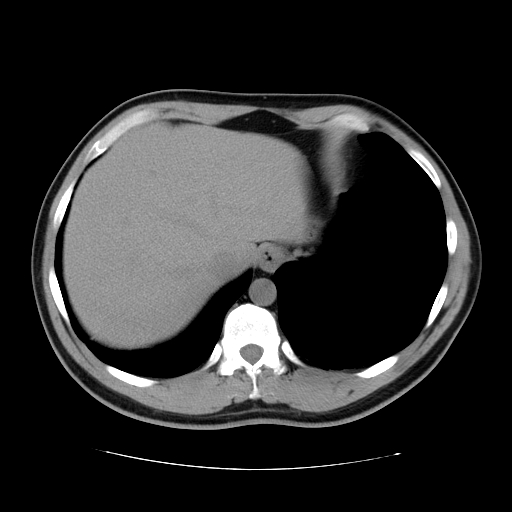 File:Obstructing ureteric calculus (Radiopaedia 18615-18514 Axial non-contrast 10).jpg