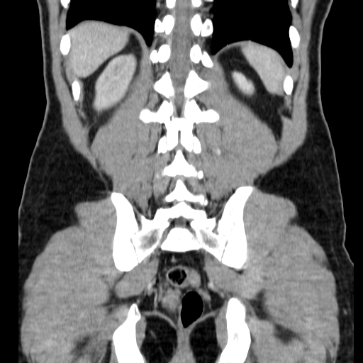 File:Obstructing ureteric calculus (Radiopaedia 18615-18514 C 62).jpg