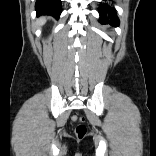 File:Obstructing ureteric calculus (Radiopaedia 18615-18514 C 66).jpg