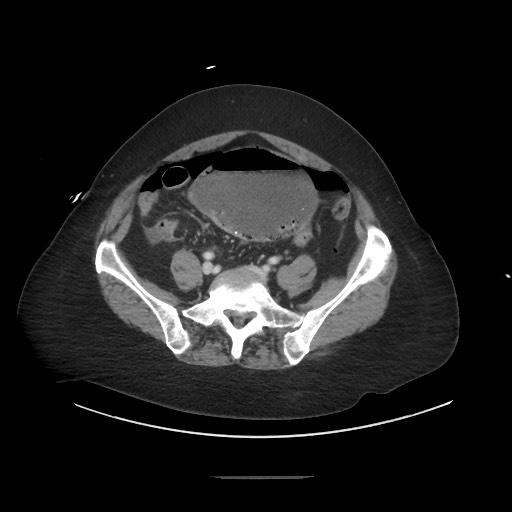 Obstructive distal colonic adenocarcinoma causing cecal perforation (Radiopaedia 86830-102989 A 141).jpg