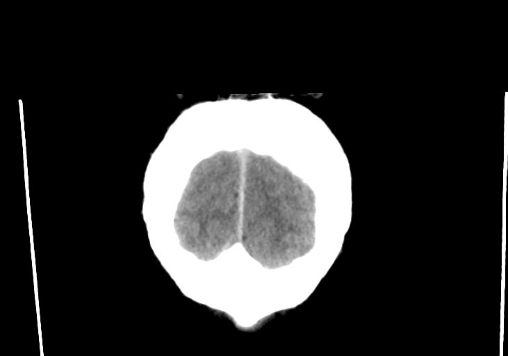 File:Obstructive hydrocephalus (Radiopaedia 30453-31119 Coronal non-contrast 37).jpg