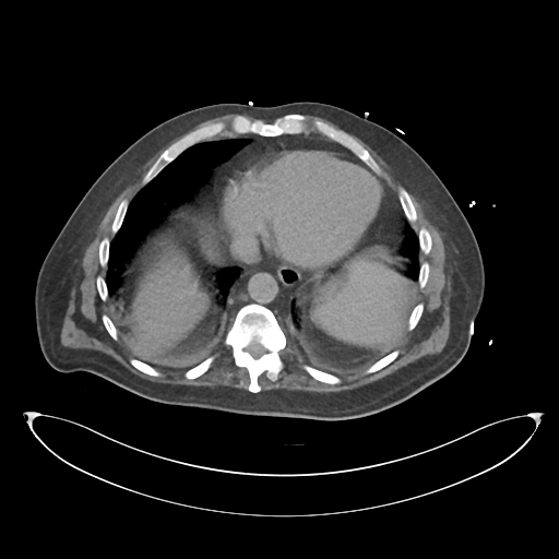 File:Obstructive pyelonephritis (Radiopaedia 46411-50844 Axial non-contrast 11).png