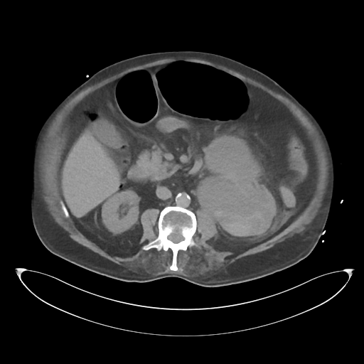 File:Obstructive pyelonephritis (Radiopaedia 46411-50844 Axial non-contrast 36).png