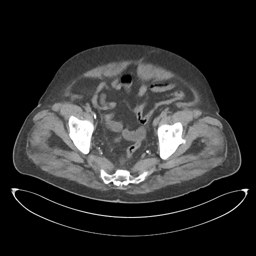 File:Obstructive pyelonephritis (Radiopaedia 46411-50844 Axial non-contrast 68).png