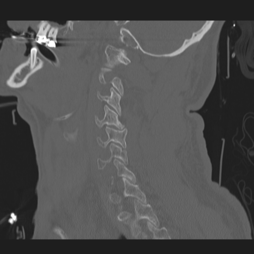 File:Occipital condyle fracture (Radiopaedia 33467-34517 Sagittal bone window 51).png