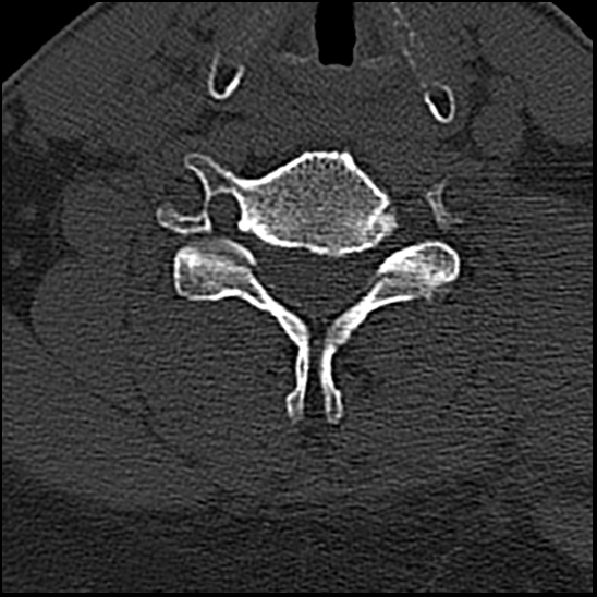 Occipital condyle fracture (type 1) (Radiopaedia 87670-104084 Axial bone window 60).jpg