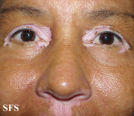 File:Vitiligo (Dermatology Atlas 24).jpg