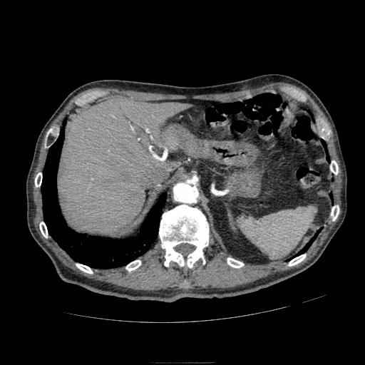 Abdominal aortic aneurysm (Radiopaedia 13341-13340 Axial C+ arterial phase 35).jpg