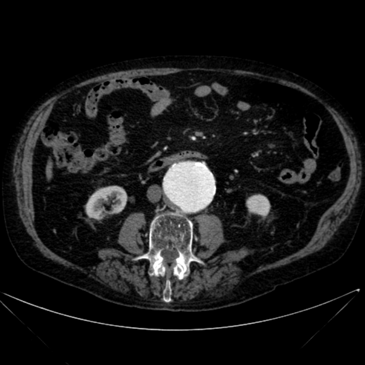 Abdominal aortic aneurysm (Radiopaedia 25855-26001 Axial C+ arterial phase 68).jpg