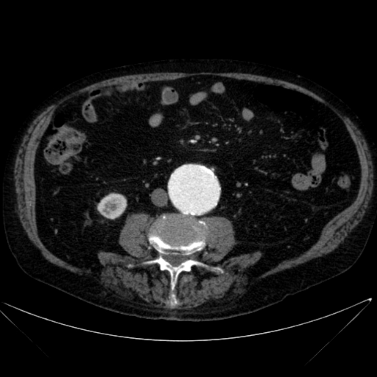 Abdominal aortic aneurysm (Radiopaedia 25855-26001 Axial C+ arterial phase 72).jpg