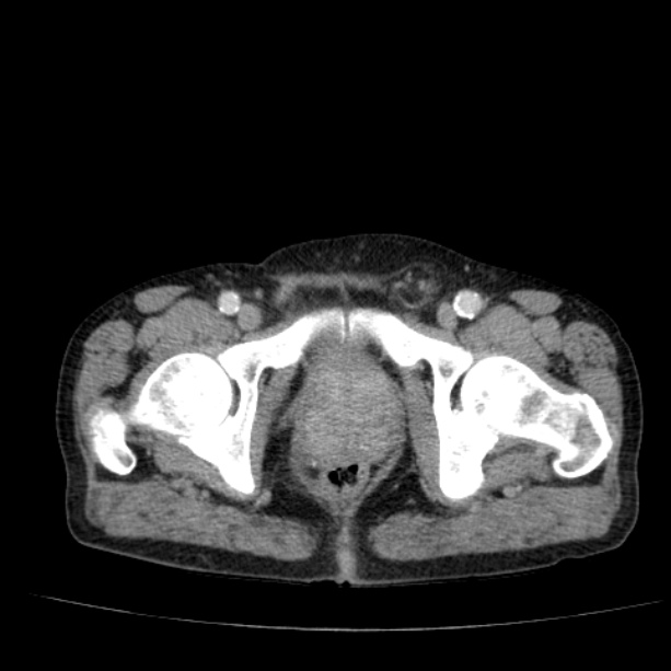 Abdominal aortic aneurysm (Radiopaedia 29248-29660 Axial C+ portal venous phase 61).jpg