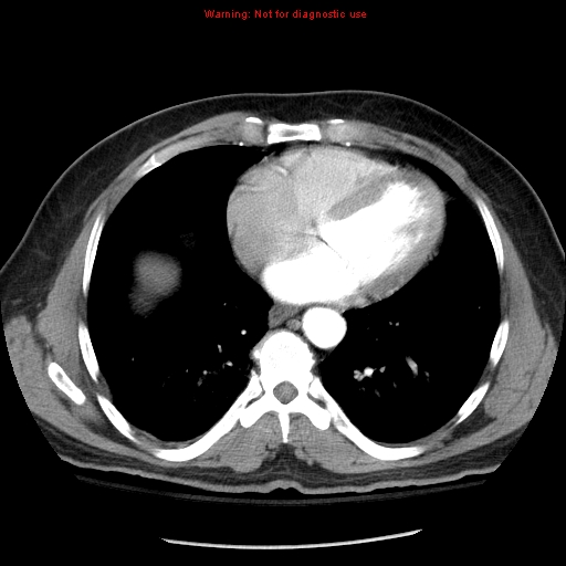 File:Abdominal aortic aneurysm (Radiopaedia 8190-9038 Axial C+ arterial phase 2).jpg