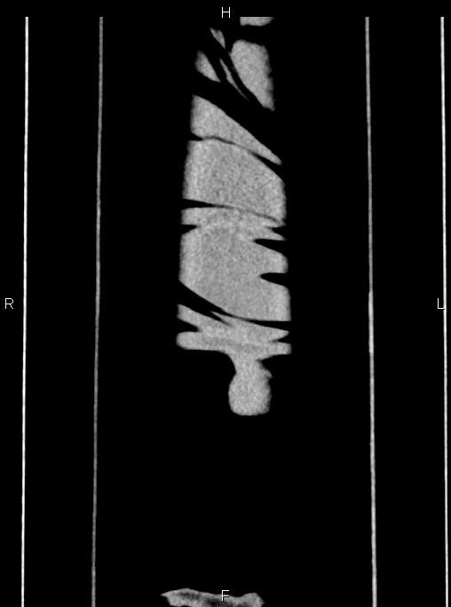 Abdominal aortic aneurysm (Radiopaedia 83094-97462 Coronal renal cortical phase 98).jpg