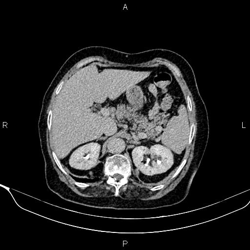 Abdominal aortic aneurysm (Radiopaedia 85063-100606 Axial C+ delayed 18).jpg