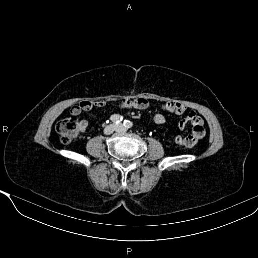 Abdominal aortic aneurysm (Radiopaedia 85063-100606 Axial C+ delayed 85).jpg