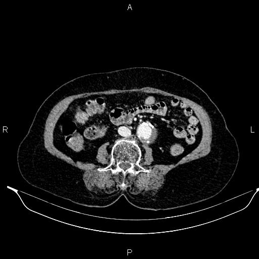 File:Abdominal aortic aneurysm (Radiopaedia 85063-100606 Axial C+ portal venous phase 43).jpg