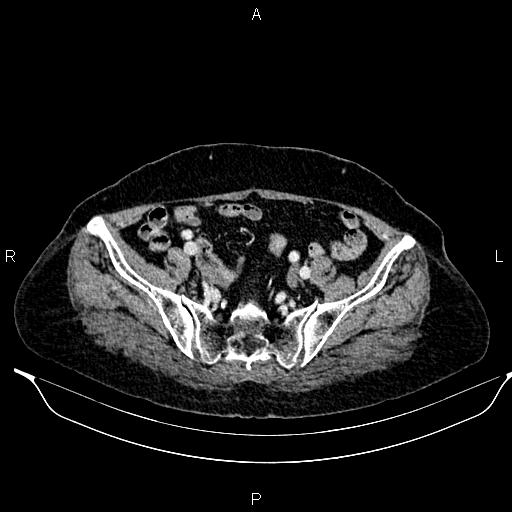 File:Abdominal aortic aneurysm (Radiopaedia 85063-100606 Axial C+ portal venous phase 56).jpg