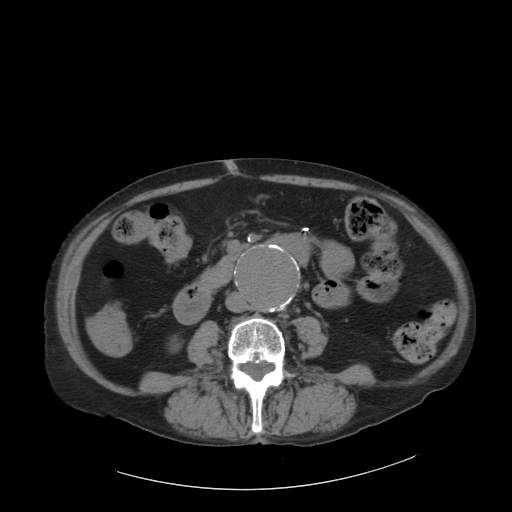 File:Abdominal aortic aneurysm (incidental finding on renal scintigraphy) (Radiopaedia 23997-24196 Axial 2).jpg