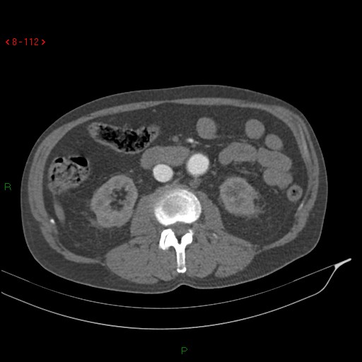 Abdominal aortic aneurysm rupture with aortocaval fistula (Radiopaedia 14897-14841 Axial C+ arterial phase 112).jpg