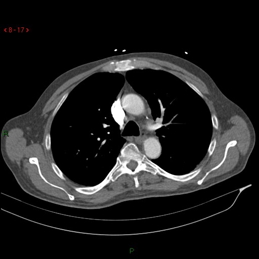 Abdominal aortic aneurysm rupture with aortocaval fistula (Radiopaedia 14897-14841 Axial C+ arterial phase 17).jpg