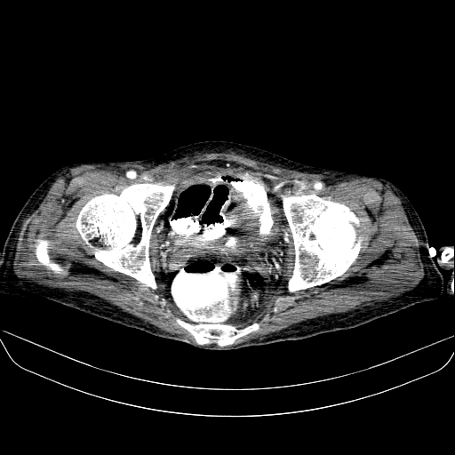 File:Abdominal collection due to previous cecal perforation (Radiopaedia 80831-94320 Axial C+ portal venous phase 191).jpg