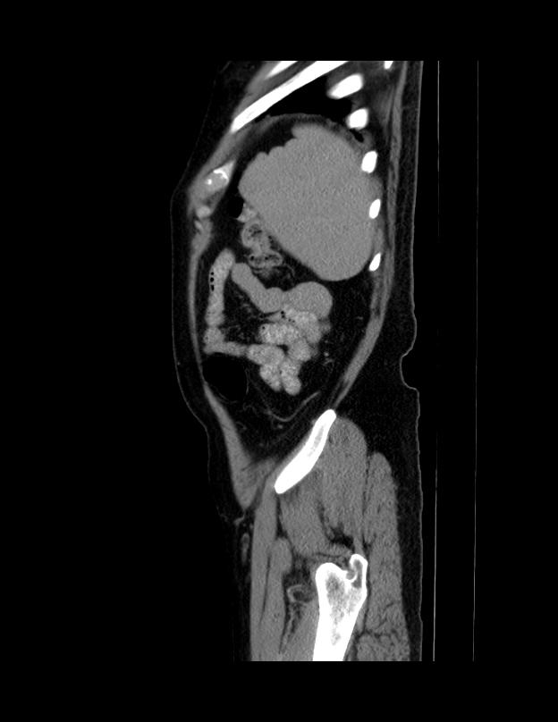Abdominal lymphoma - with sandwich sign (Radiopaedia 53486-59492 Sagittal C+ portal venous phase 8).jpg