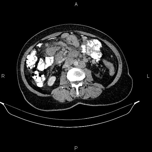 File:Abdominal lymphoma with sandwich sign (Radiopaedia 84378-99704 Axial C+ portal venous phase 31).jpg