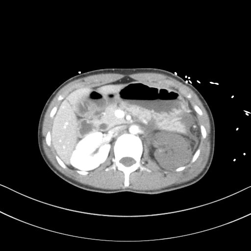 File:Abdominal multi-trauma - devascularised kidney and liver, spleen and pancreatic lacerations (Radiopaedia 34984-36486 Axial C+ portal venous phase 29).png