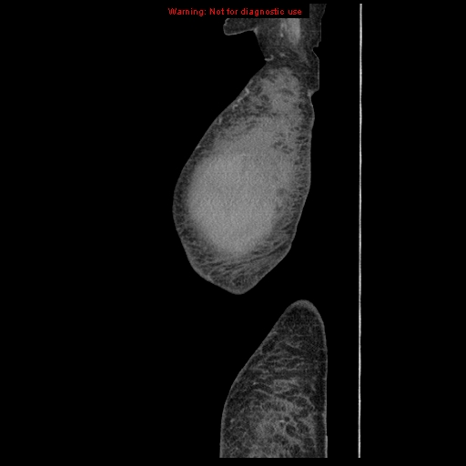 File:Abdominal wall hematoma (Radiopaedia 9427-10112 Sagittal C+ portal venous phase 110).jpg