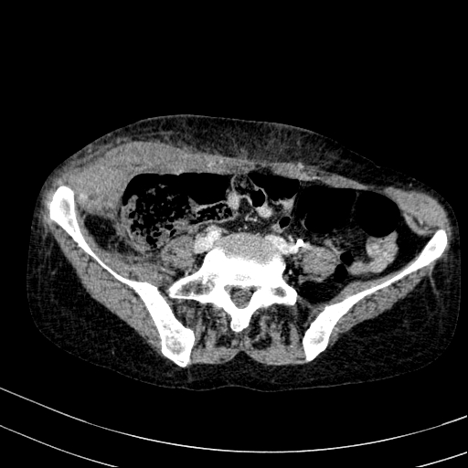 Abdominal wall hematoma with active bleeding (Radiopaedia 83915-99117 Axial C+ portal venous phase 86).jpg