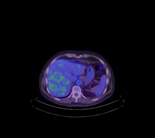 Abdominal wall metastasis from colorectal carcinoma (Radiopaedia 31016-31719 Axial 89).jpg
