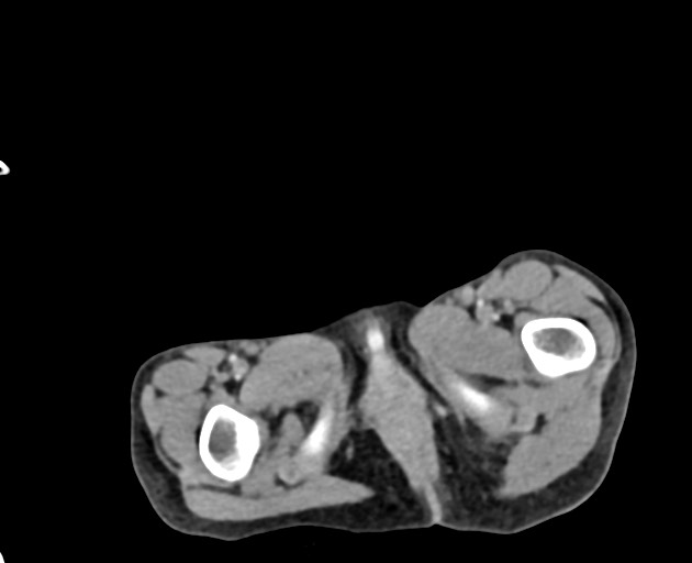 File:Abdominopelvic rhabdomyosarcoma (Radiopaedia 78356-90984 Axial C+ portal venous phase 163).jpg