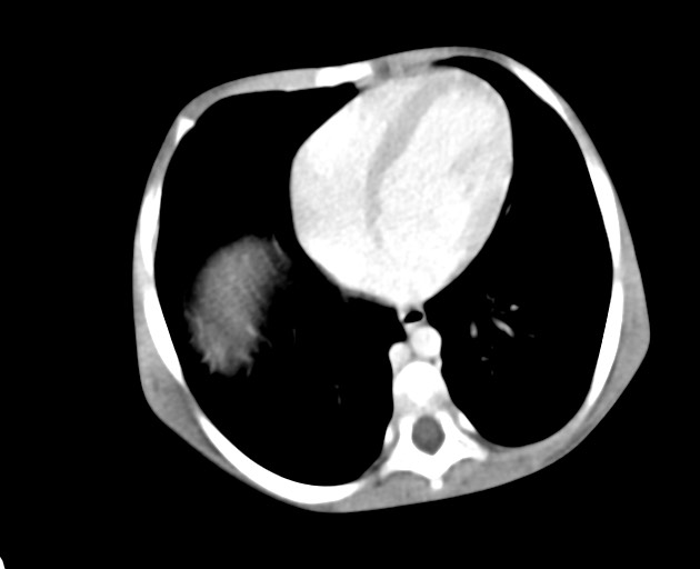 Abdominopelvic rhabdomyosarcoma (Radiopaedia 78356-90984 Axial C+ portal venous phase 31).jpg