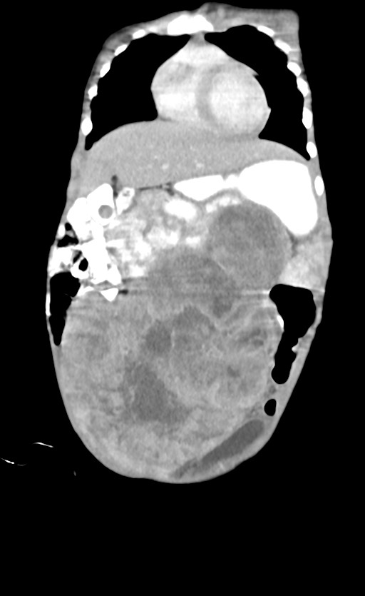 Abdominopelvic rhabdomyosarcoma (Radiopaedia 78356-90984 Coronal C+ portal venous phase 24).jpg