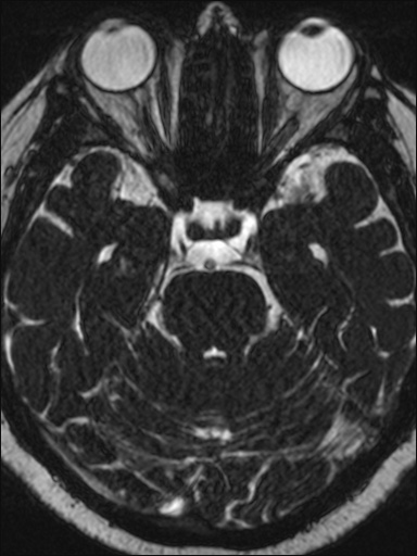Abducens nerve palsy (Radiopaedia 57084-63976 Axial T2 ciss 3d 42).jpg