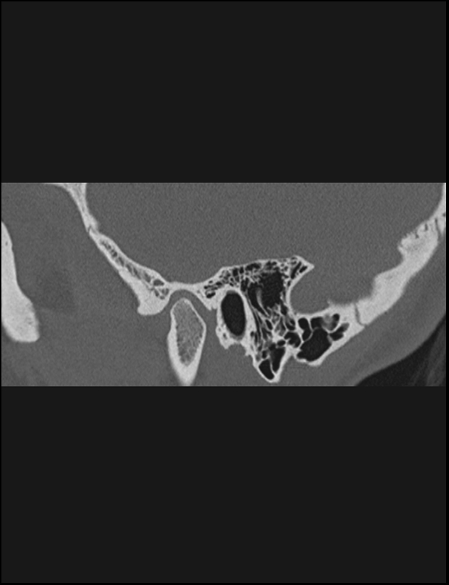 Aberrant right internal carotid artery (Radiopaedia 65191-74198 Sagittal non-contrast 31).jpg