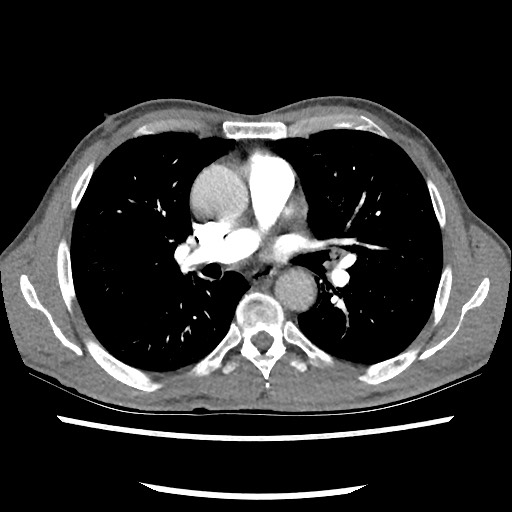 Accessory left horizontal fissure with lingular pneumonia (Radiopaedia 53763-59843 Axial C+ CTPA 46).jpg