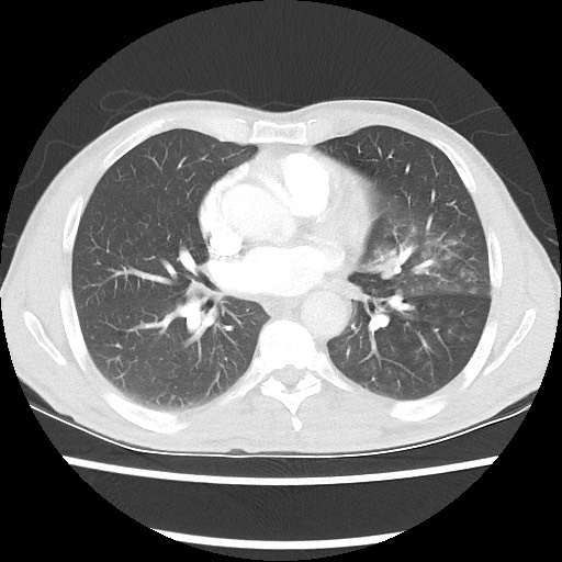 Accessory left horizontal fissure with lingular pneumonia (Radiopaedia 53763-59843 Axial lung window 32).jpg