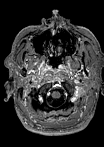 Accessory middle cerebral artery (Radiopaedia 73114-83828 Axial T1 C+ 189).jpg