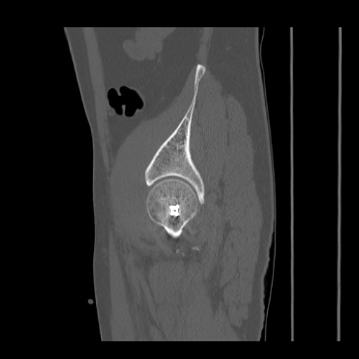Acetabular and ilial fractures (Radiopaedia 59084-66378 Sagittal bone window 79).jpg