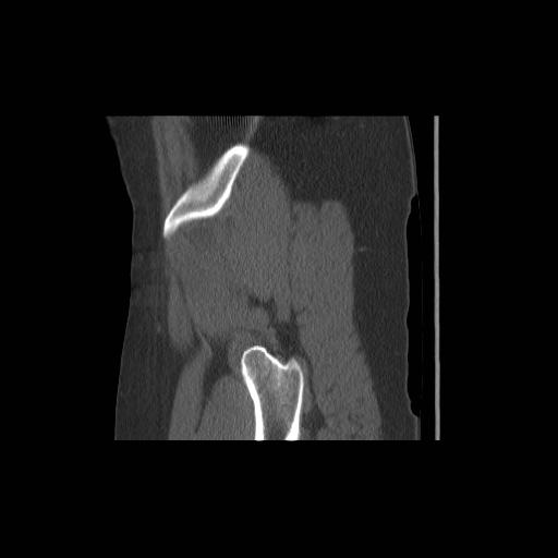 File:Acetabular fracture (Radiopaedia 13193-13212 Sagittal bone window 10).jpg