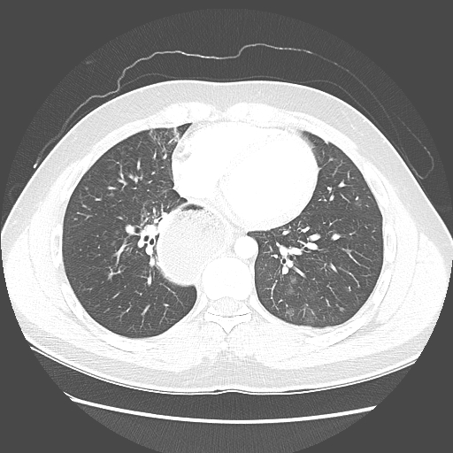 Achalasia (Radiopaedia 52507-58417 Axial lung window 40).jpg