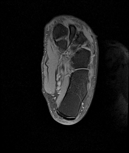 File:Achilles tendon tear (Radiopaedia 77615-89819 Axial PD fat sat 24).jpg