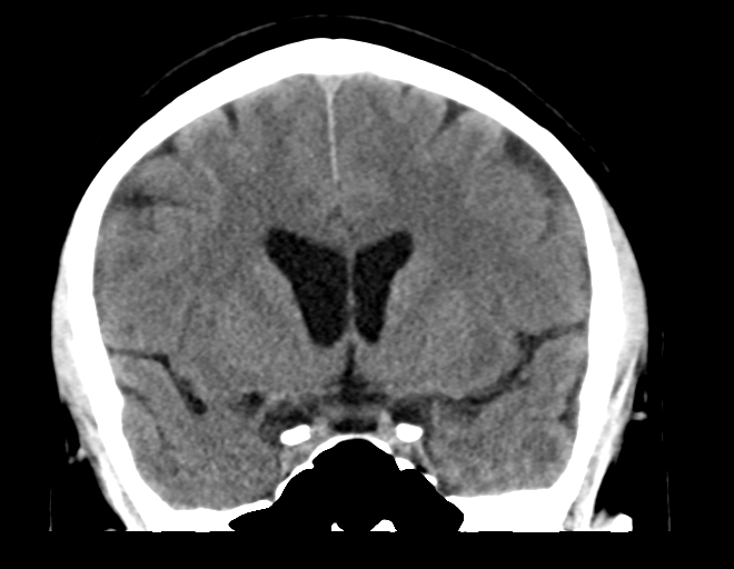 File:Acoustic schwannoma (Radiopaedia 33045-34065 Coronal non-contrast 20).png