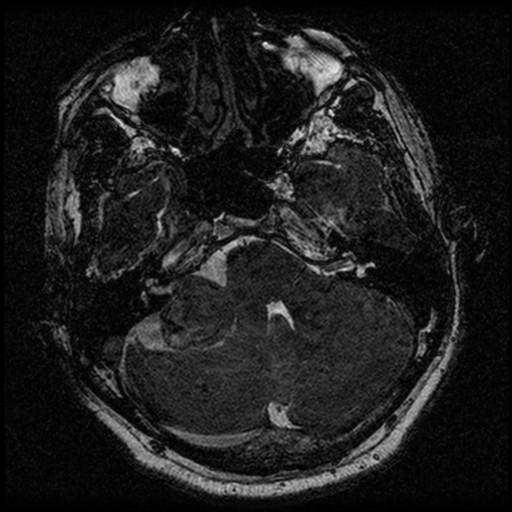 File:Acoustic schwannoma (Radiopaedia 39170-41387 Axial FIESTA 65).png
