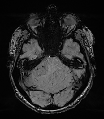 Acoustic schwannoma (Radiopaedia 50846-56358 Axial SWI 28).png