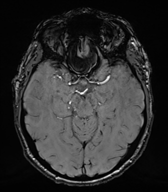 File:Acoustic schwannoma (Radiopaedia 50846-56358 Axial SWI 37).png