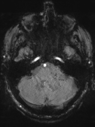 Acoustic schwannoma (Radiopaedia 55729-62281 Axial SWI 11).png