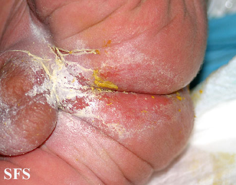 File:Acrodermatitis Enteropathica (Dermatology Atlas 25).jpg