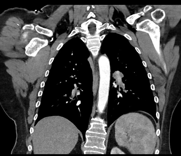 File:Acromioclavicular joint cyst (Radiopaedia 58455-65610 Coronal C+ arterial phase 96).jpg